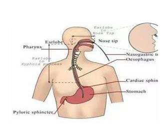 插入胃管的操作方法